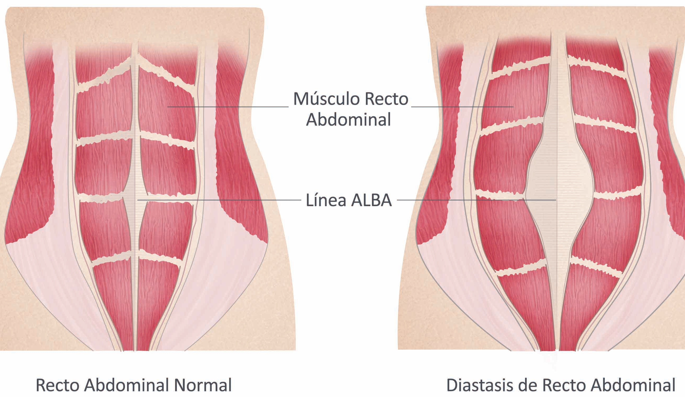 Electroestimulación para recto abdominal y diástasis 